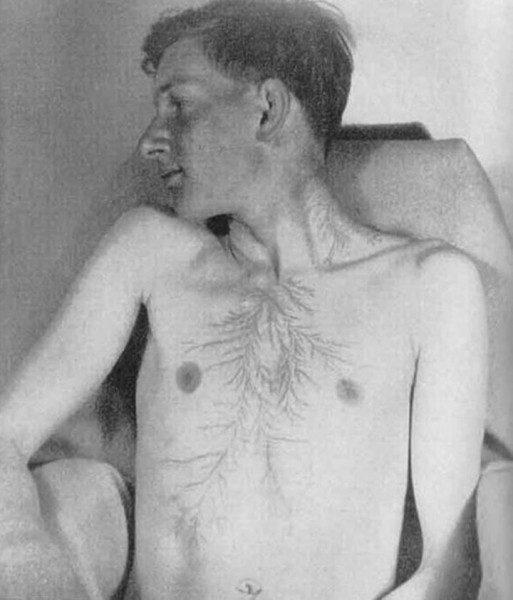 После разряда — что происходит с человеком, в которого ударила молния