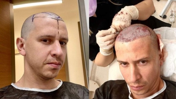 «Потратил 2 тысячи долларов – было весело». Белорус рассказал о трансплантации волос в Турции «Потратил 2 тысячи долларов – было весело». Белорус рассказал о трансплантации волос в Турции